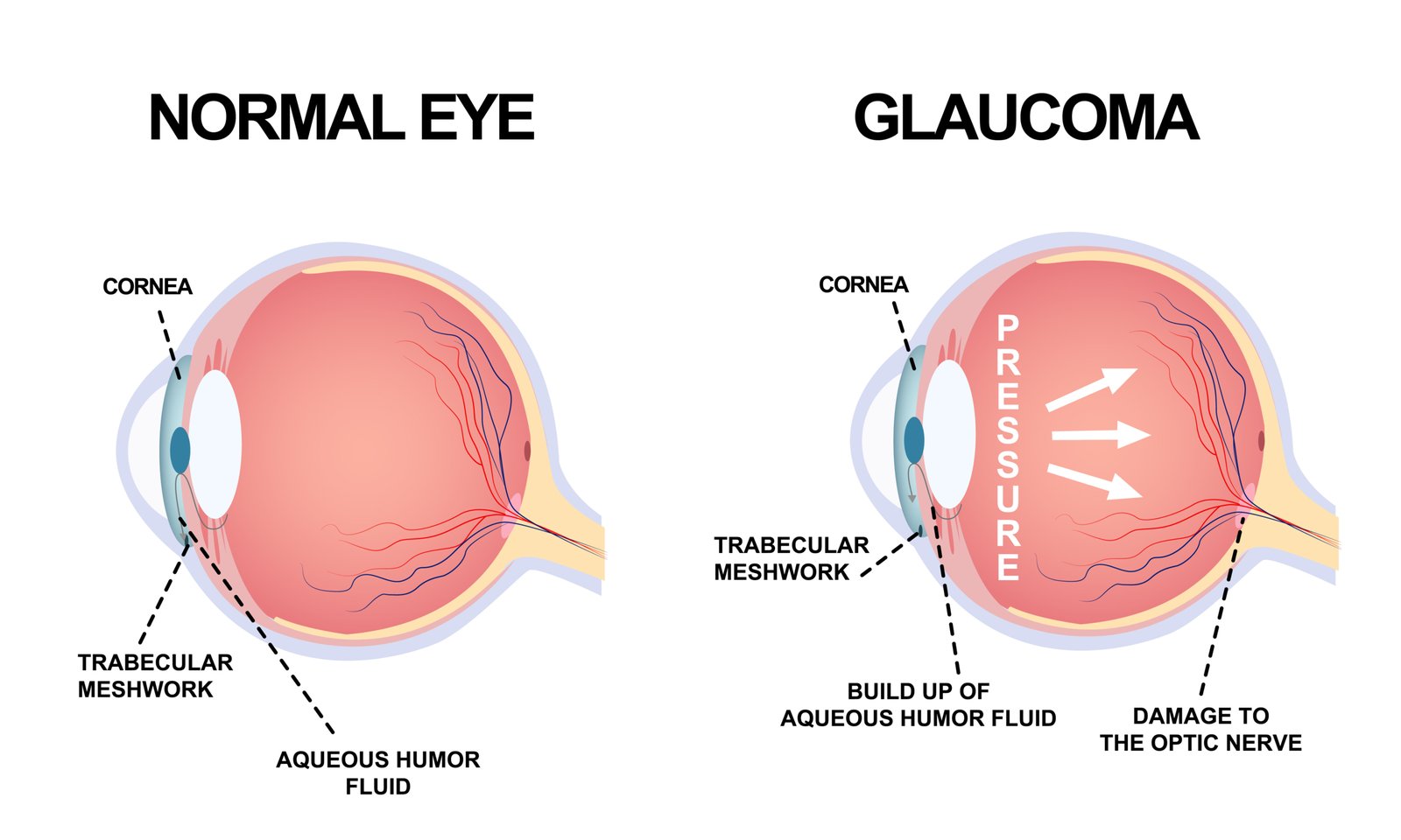 glaucoma illustration adobestock 370587591 scaled