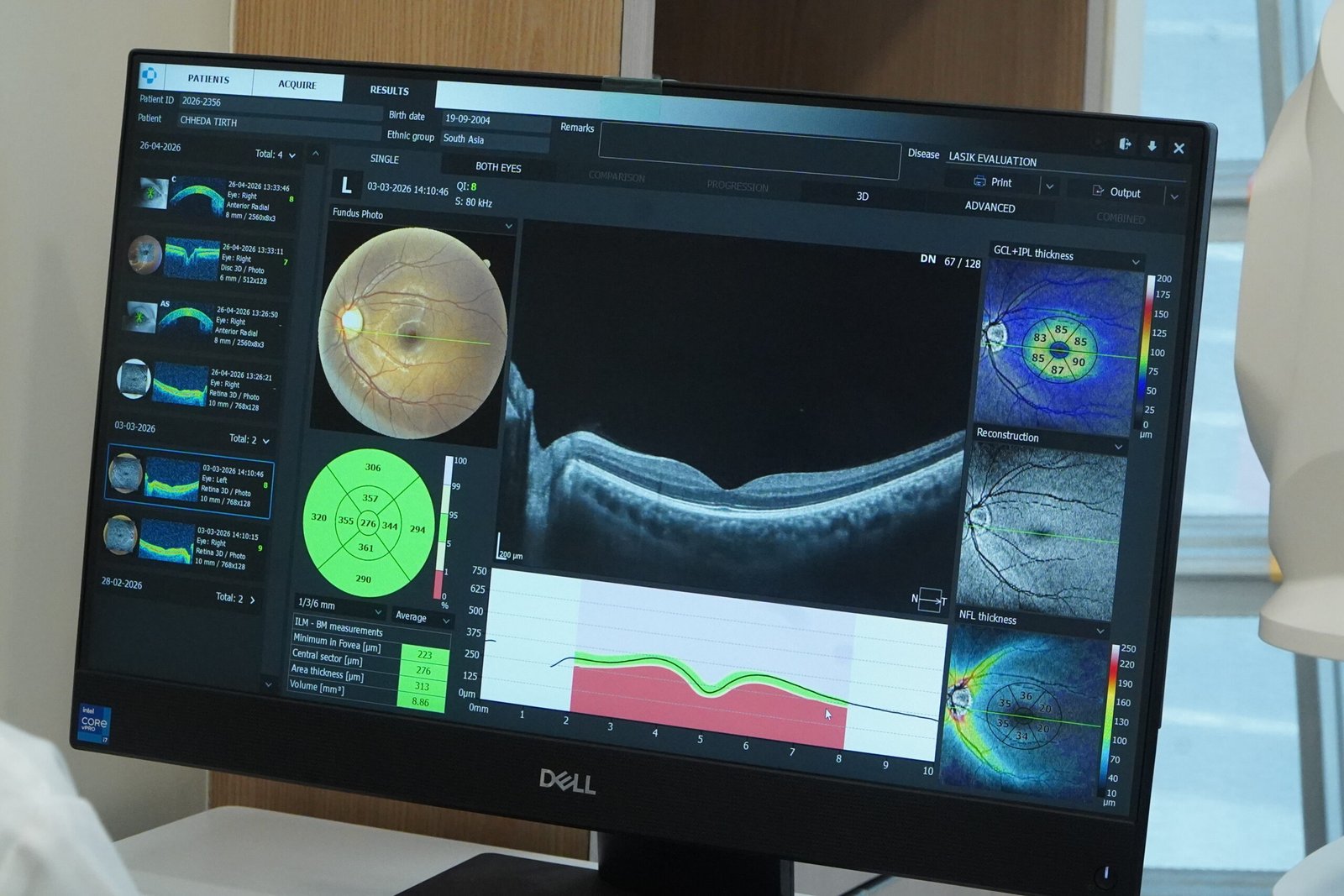HVF test vs OCT — OCT report screen at Dr Jignesh Gala's clinic Andheri West showing RNFL and retinal analysis